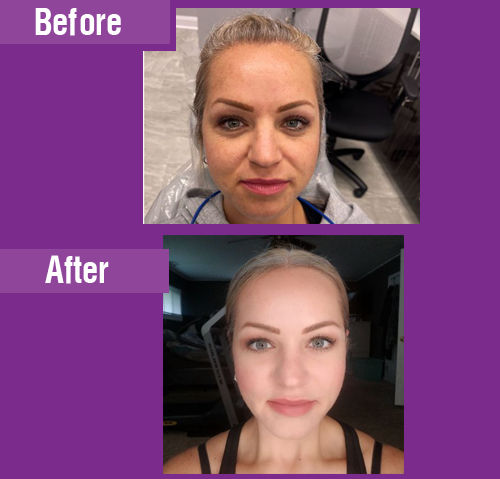 Facial muscle relaxation treatment before and after result 1